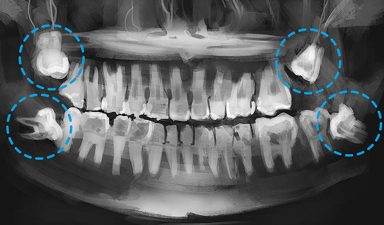 dentes do siso